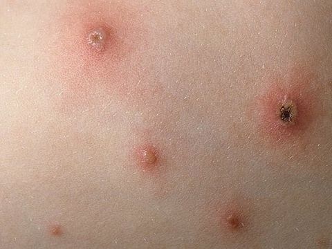 TUYÊN TRUYỀN PHÒNG CHỐNG BỆNH THỦY ĐẬU