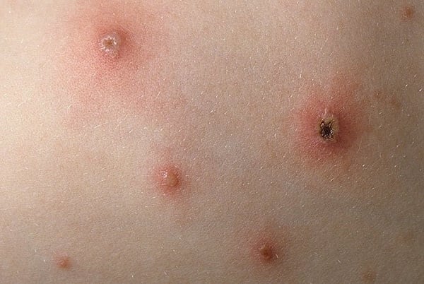 Ảnh trong bài: TUYÊN TRUYỀN PHÒNG CHỐNG BỆNH THỦY ĐẬU